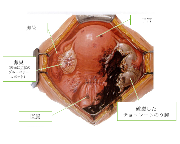 びまん性骨盤子宮内膜症