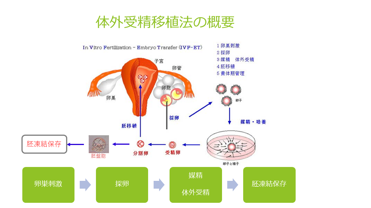 体外受精移植法